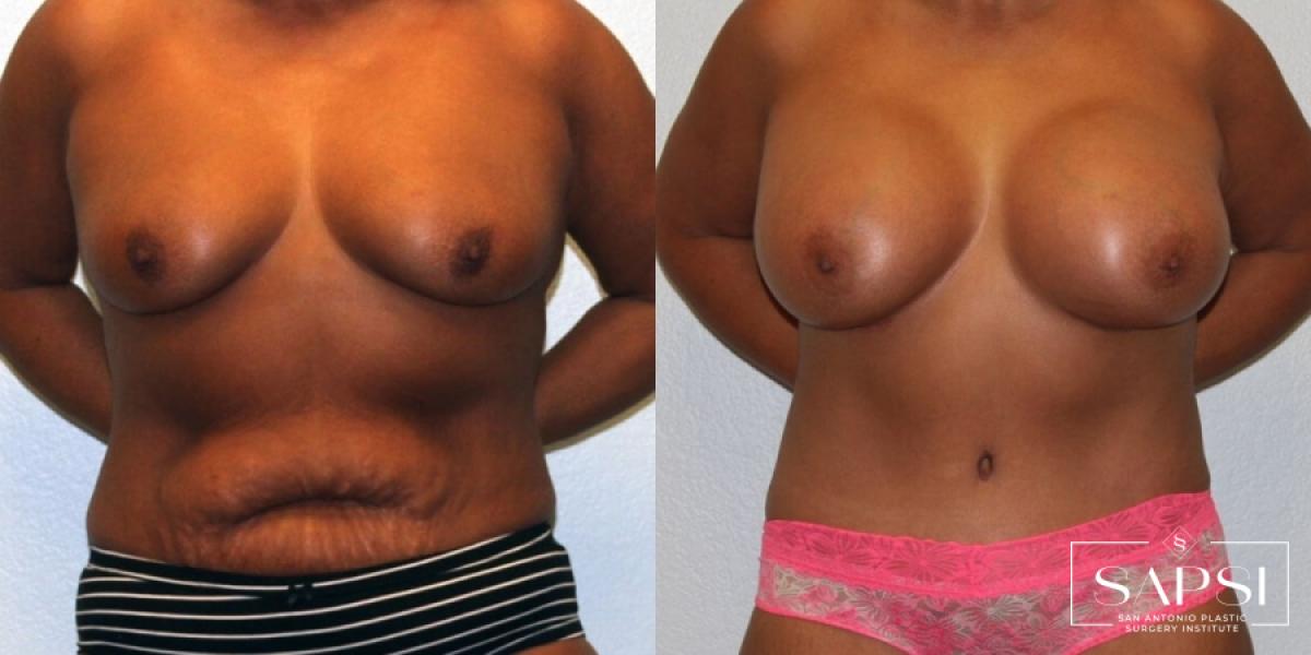 Body Contouring: Patient 6 - Before