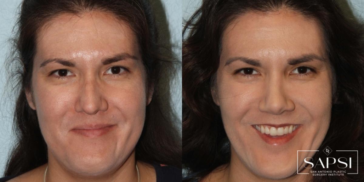 Facelift: Patient 1 - Before