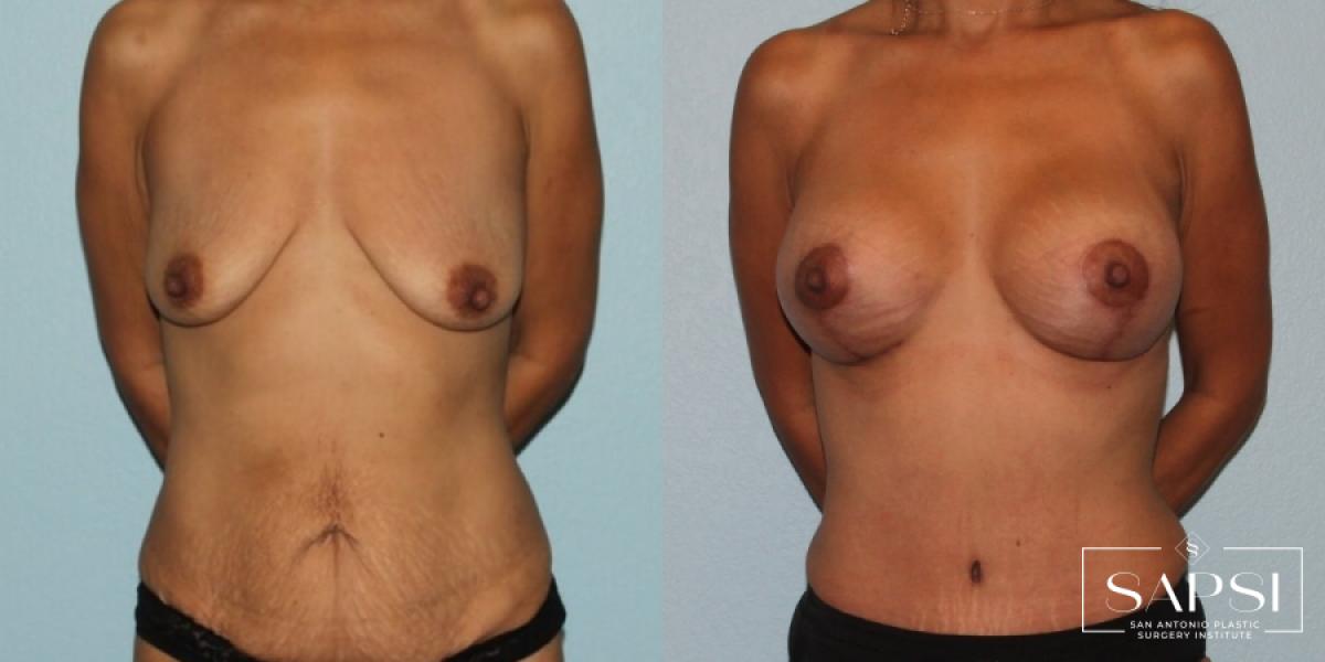 Breast Augmentation With Lift: Patient 5 - Before