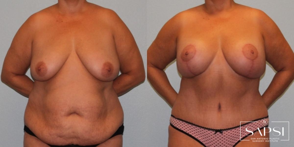 Breast Augmentation With Lift: Patient 14 - Before and After 