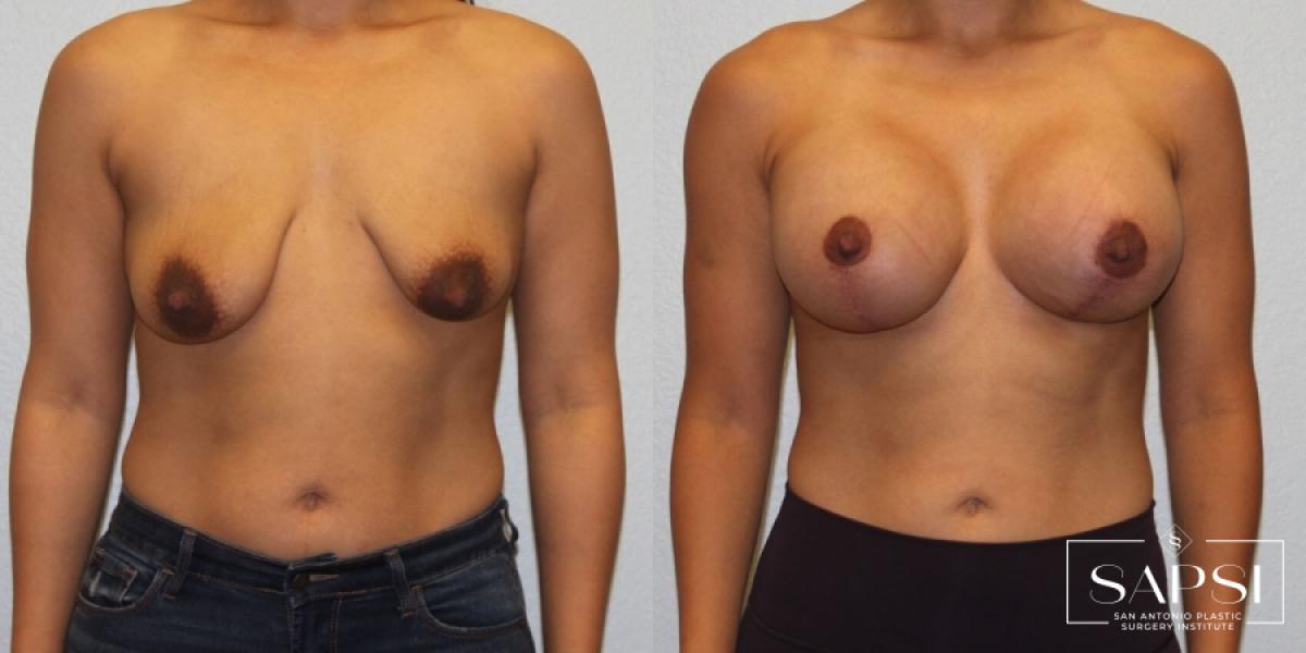 Breast Augmentation With Lift: Patient 1 - Before