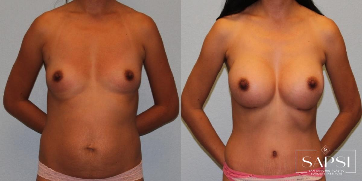 Mommy Makeover: Patient 17 - Before and After 