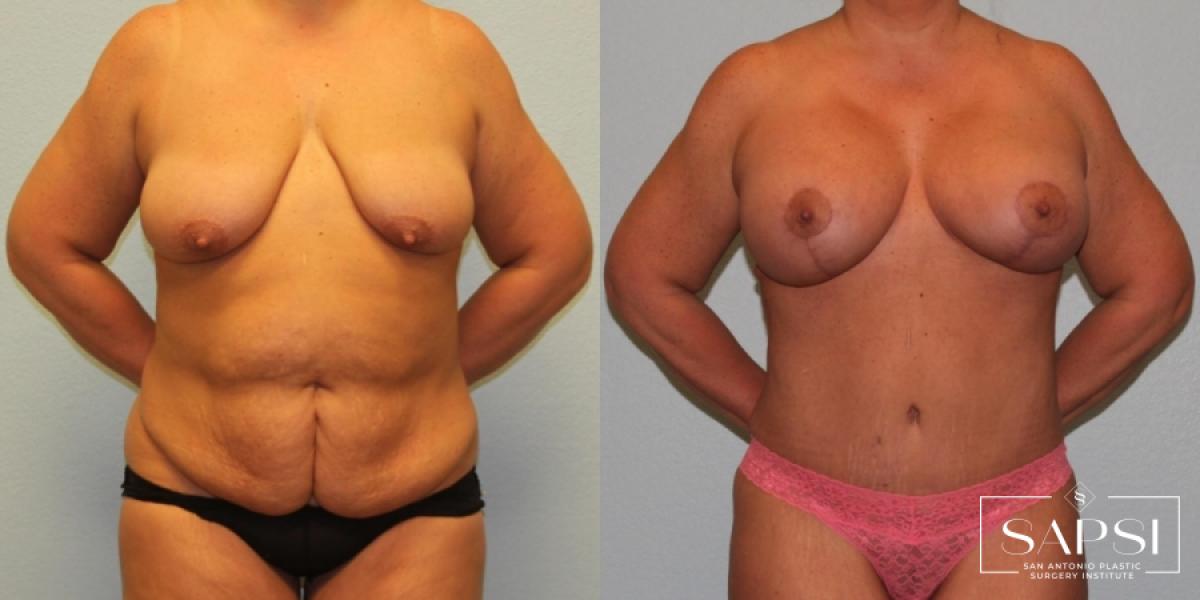 Breast Augmentation With Lift: Patient 12 - Before and After 