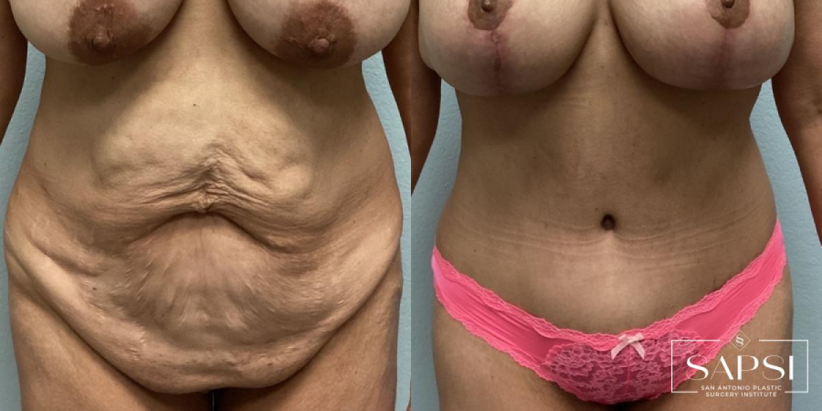 Tummy Tuck: Patient 7 - Before