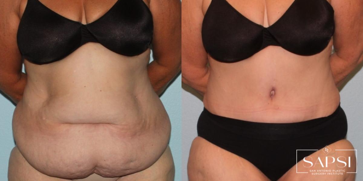 Liposuction: Patient 15 - Before and After 
