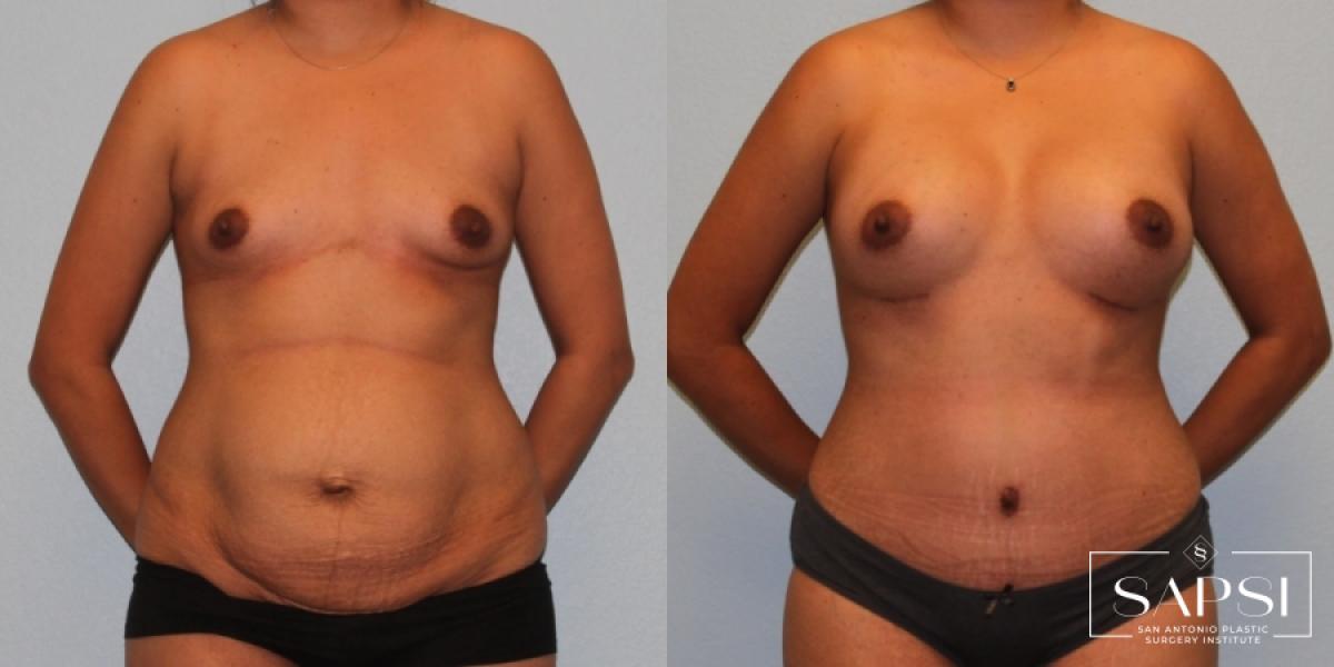 Mommy Makeover: Patient 19 - Before and After 