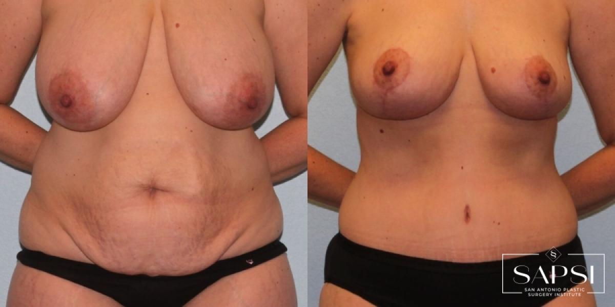 Mommy Makeover: Patient 21 - Before and After 