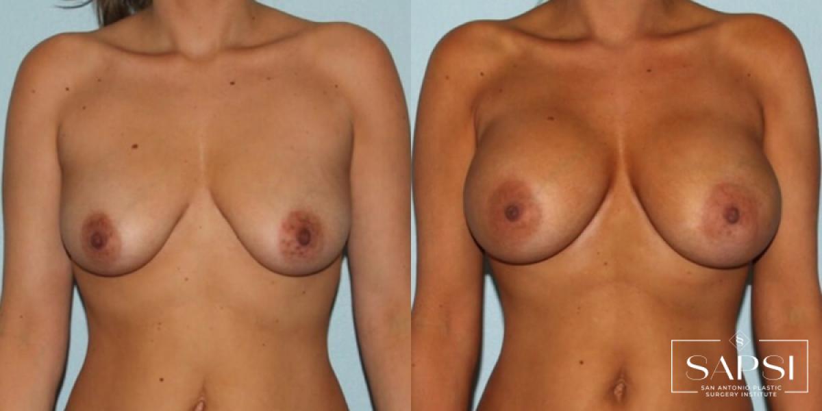 Breast Augmentation: Patient 2 - Before
