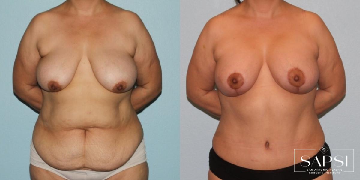 Breast Lift: Patient 6 - Before