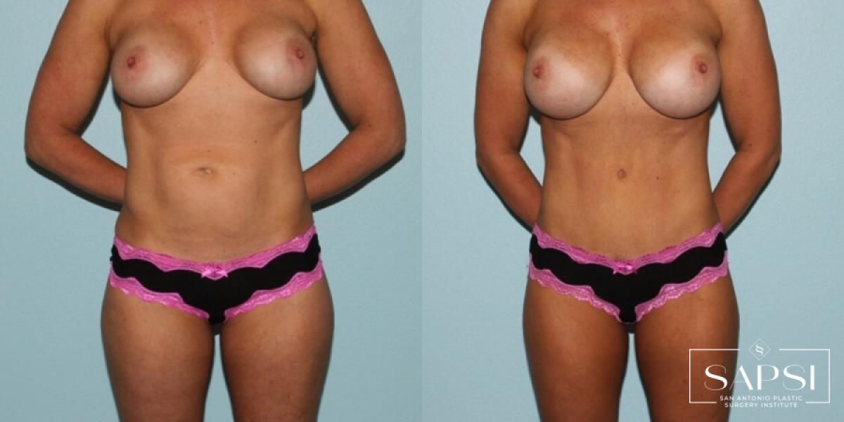 Breast Revision: Patient 10 - Before