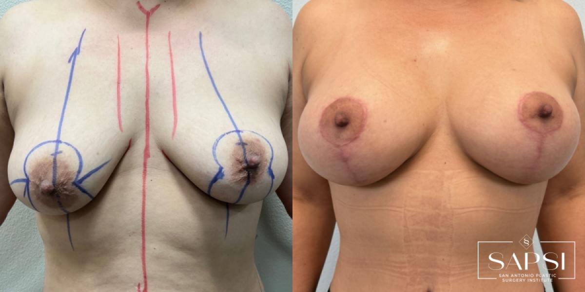 Breast Augmentation With Lift: Patient 23 - Before and After 