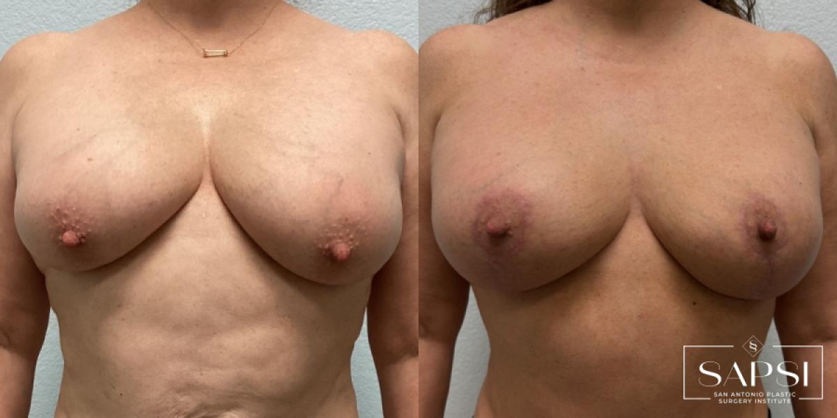 Breast Reduction: Patient 6 - Before