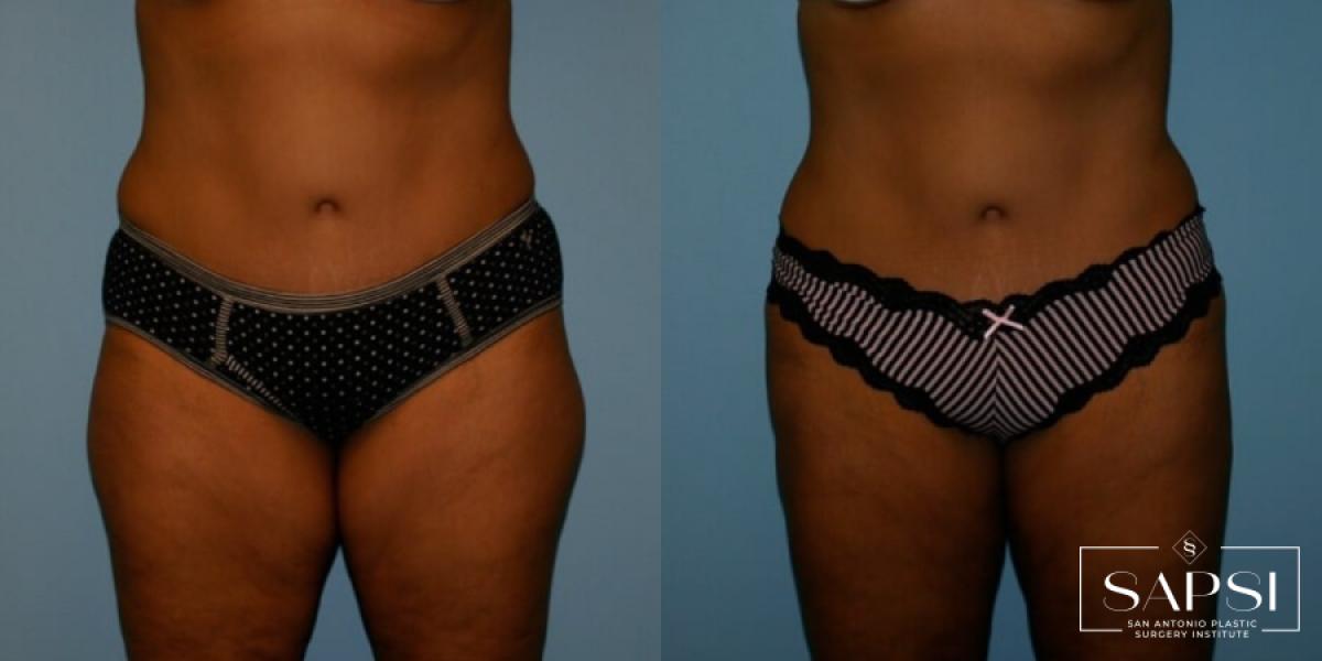 Liposuction: Patient 10 - Before
