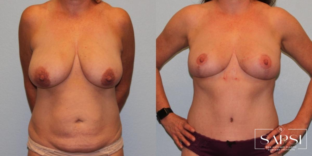Mommy Makeover: Patient 9 - Before