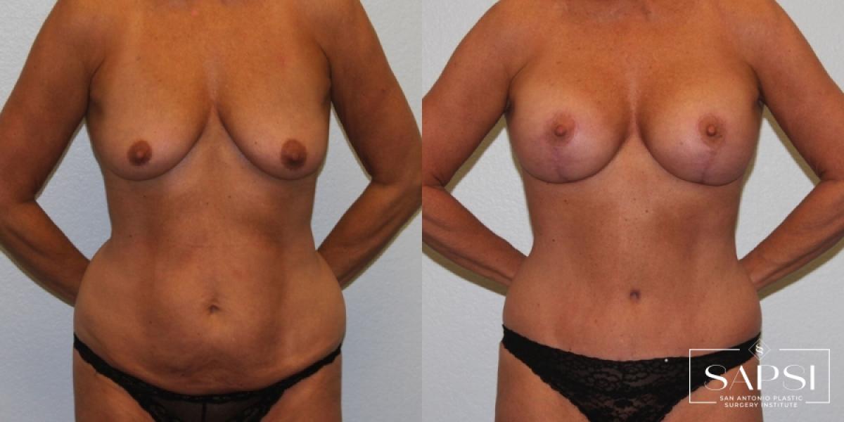 Breast Lift: Patient 7 - Before