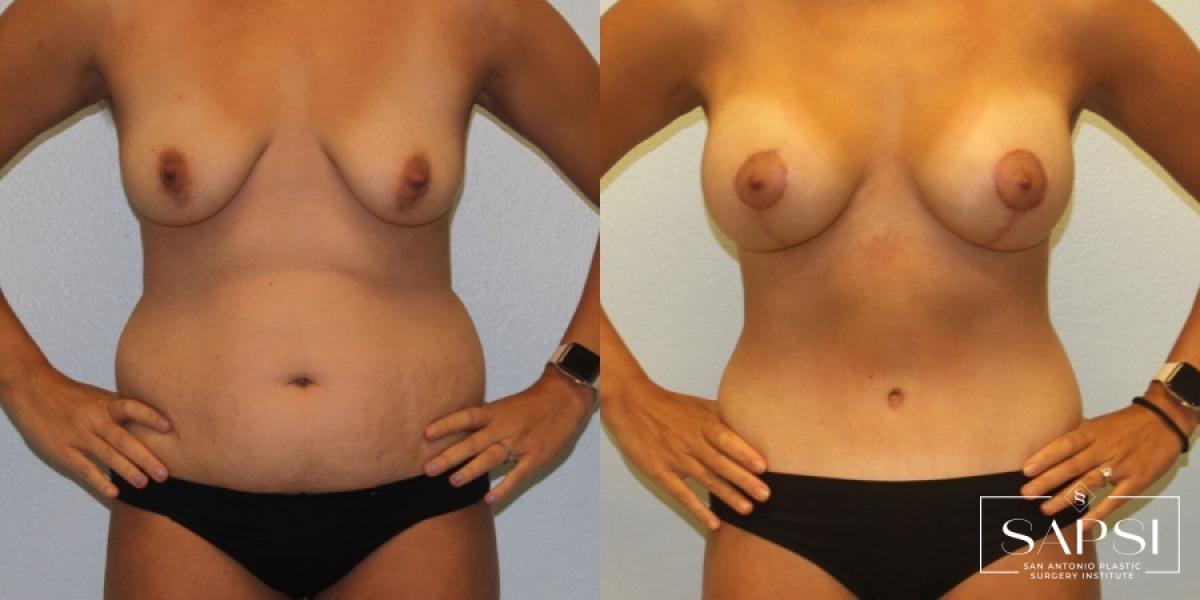 Breast Augmentation With Lift: Patient 2 - Before