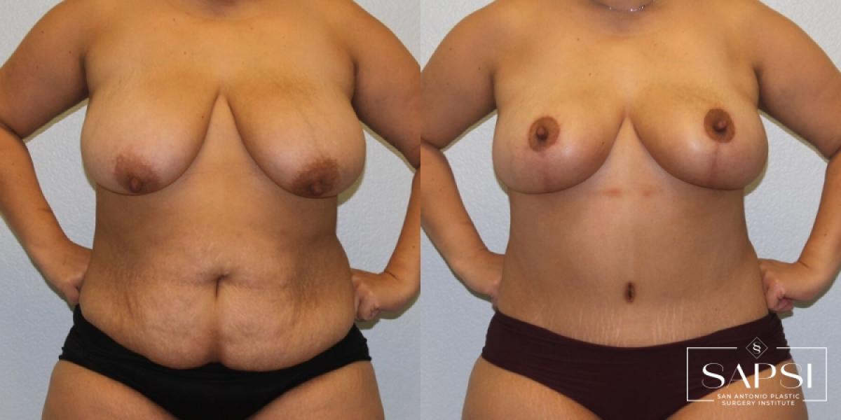 Breast Lift: Patient 2 - Before