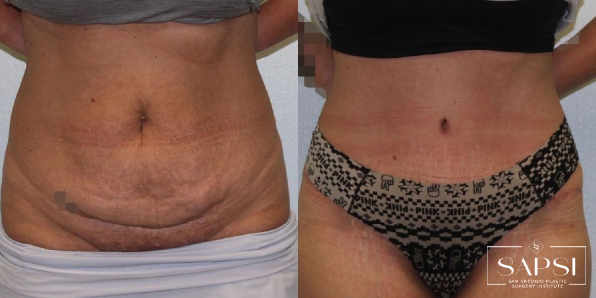 Tummy Tuck: Patient 23 - Before and After 
