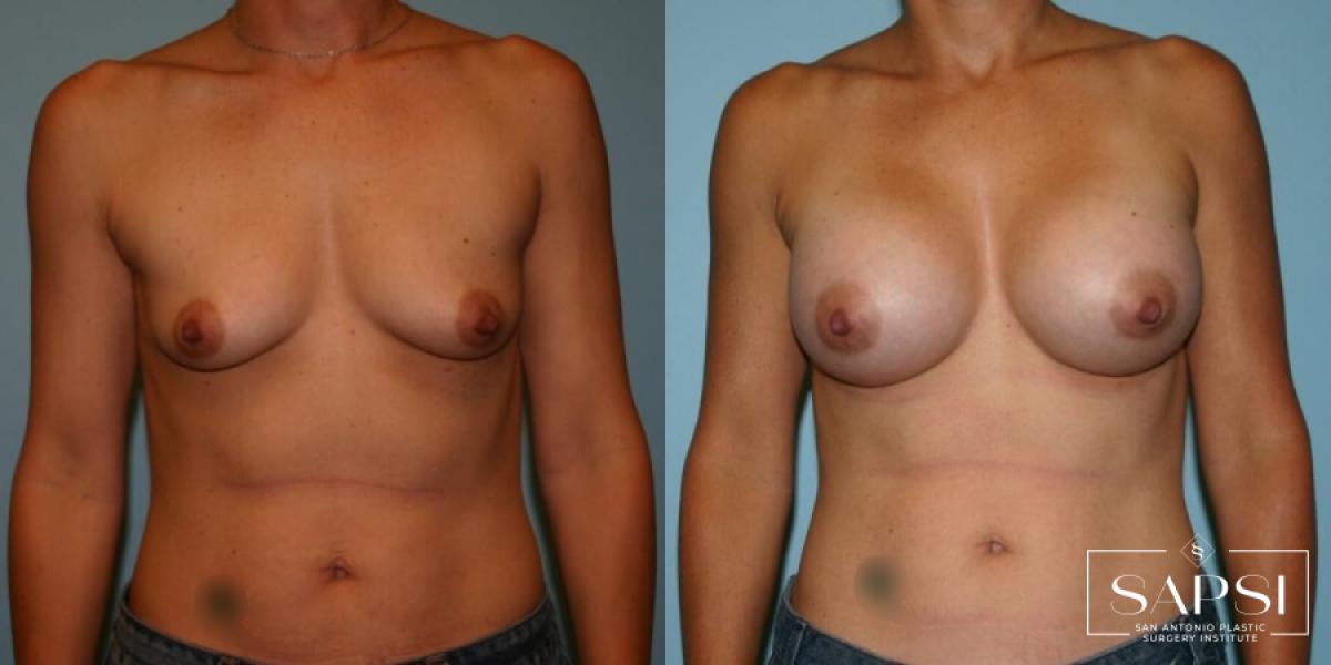 Breast Augmentation: Patient 5 - Before