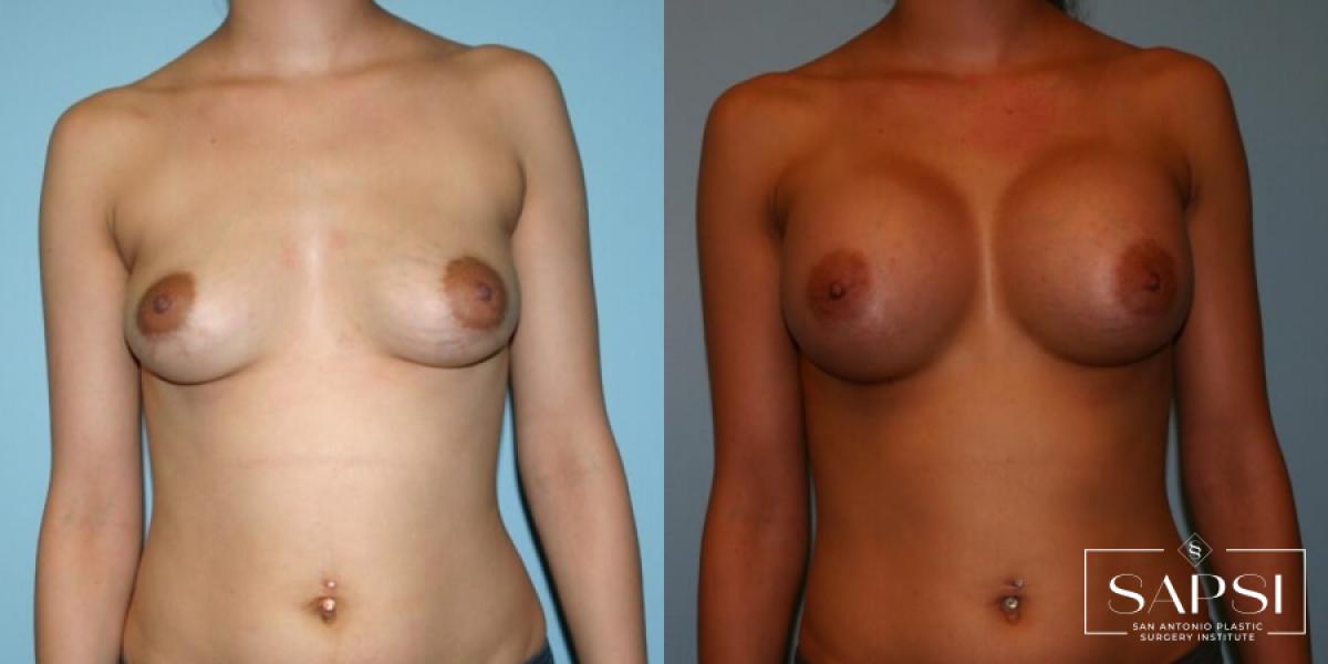 Breast Augmentation: Patient 10 - Before