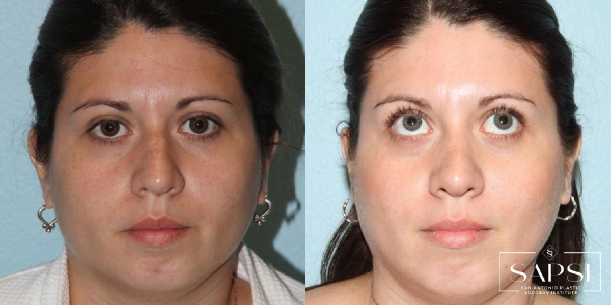 Facelift: Patient 7 - Before