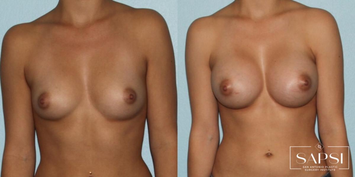 Breast Augmentation: Patient 4 - Before