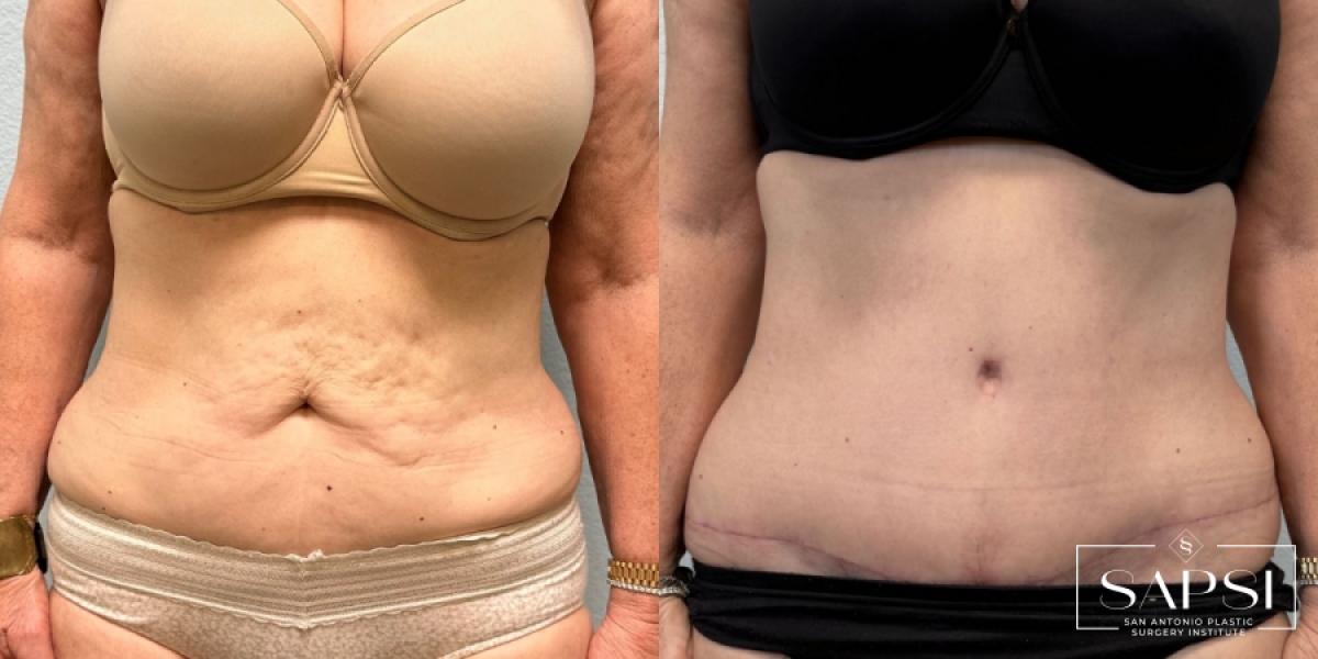 Tummy Tuck: Patient 4 - Before