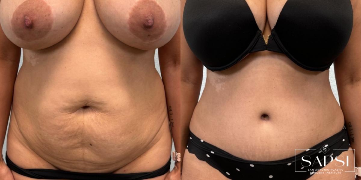 Tummy Tuck: Patient 2 - Before