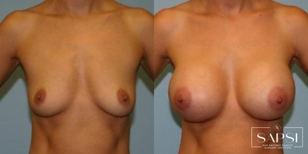 Breast Augmentation: Patient 1 - Before