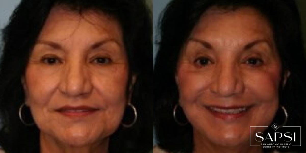 Facelift: Patient 5 - Before