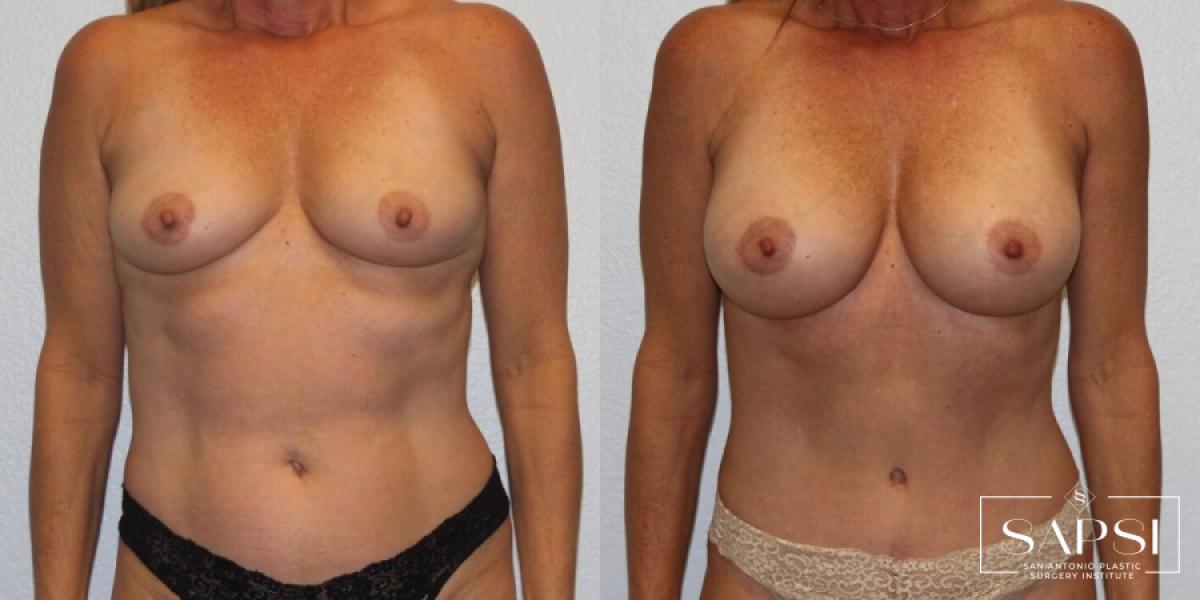 Mommy Makeover: Patient 42 - Before and After 