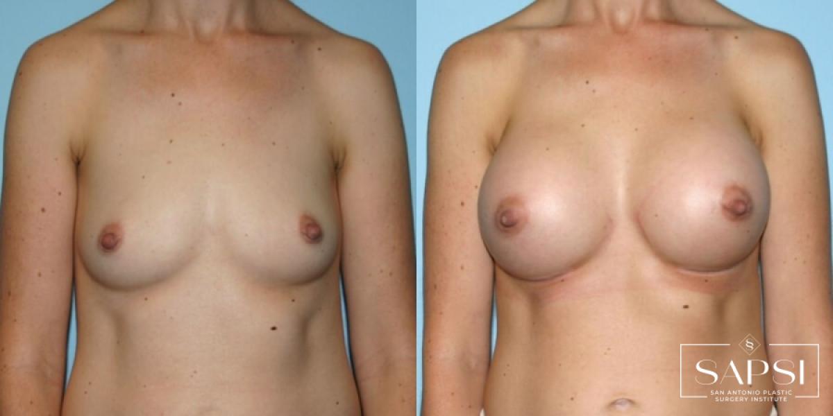 Breast Augmentation: Patient 6 - Before