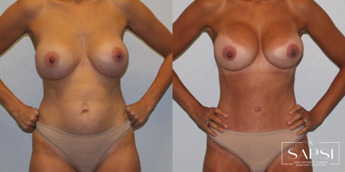 Breast Revision: Patient 5 - Before