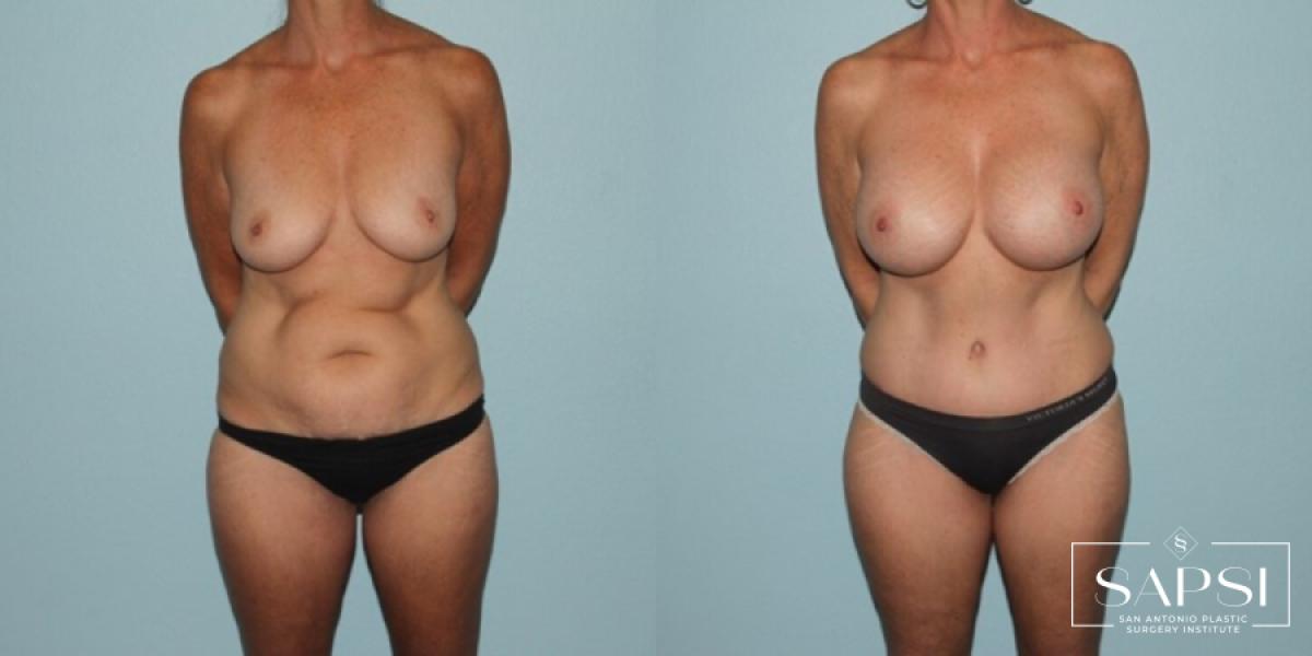 Mommy Makeover: Patient 8 - Before