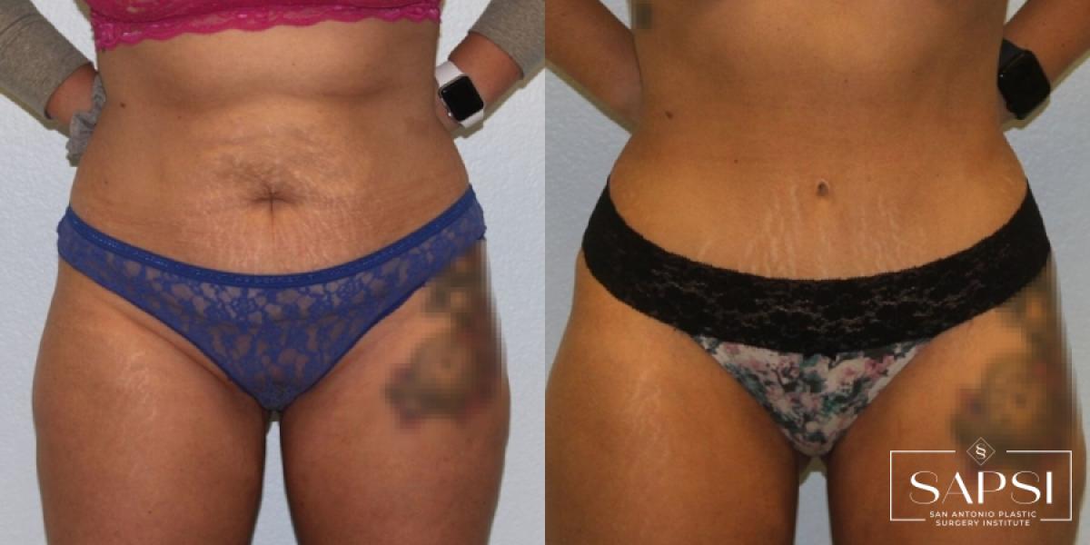 Tummy Tuck: Patient 10 - Before