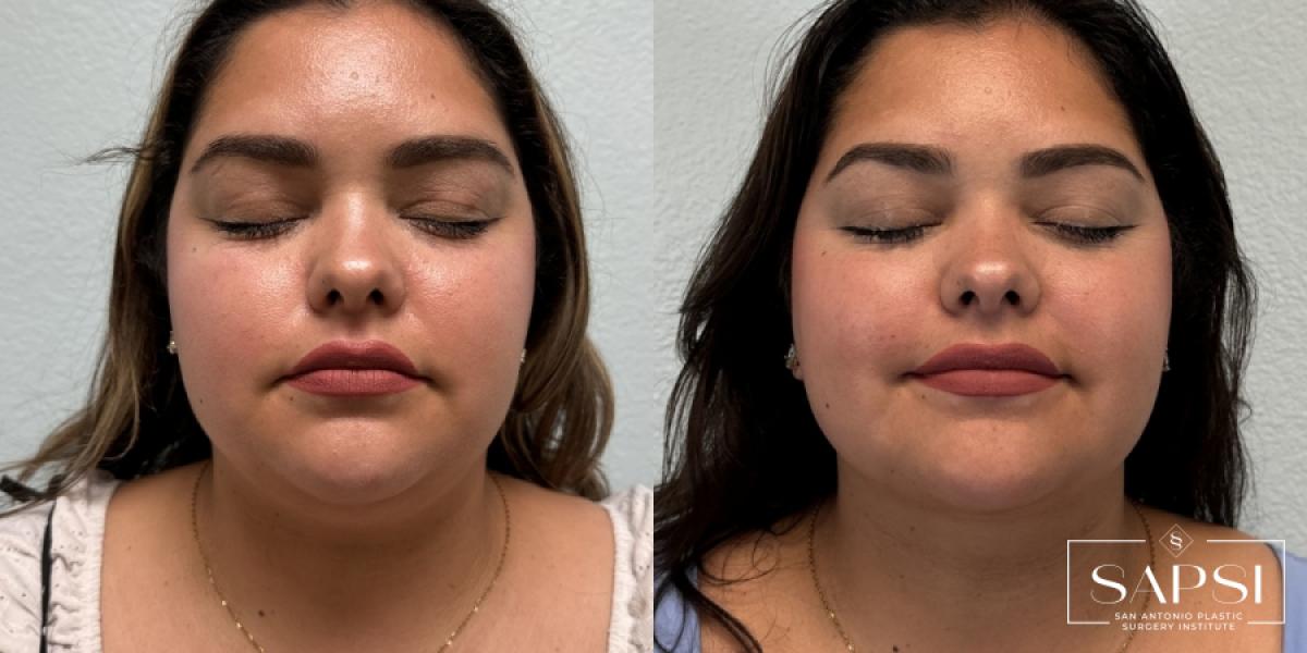 Liposuction: Patient 1 - Before