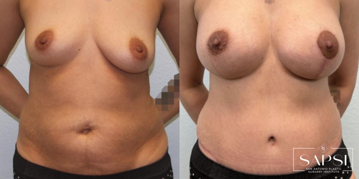 Tummy Tuck: Patient 6 - Before