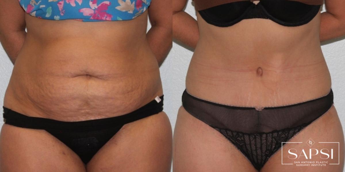 Body Contouring: Patient 4 - Before