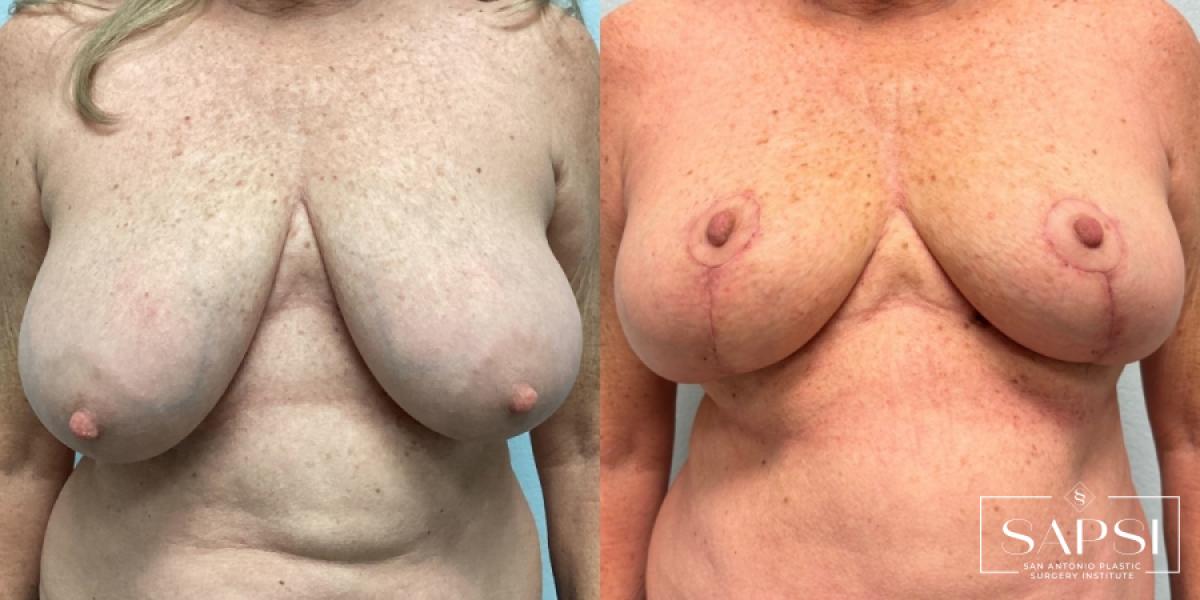Breast Reduction: Patient 1 - Before