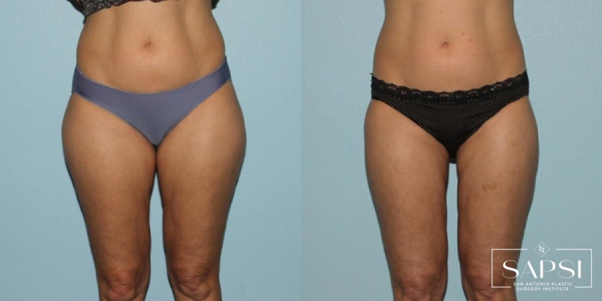 Liposuction: Patient 8 - Before