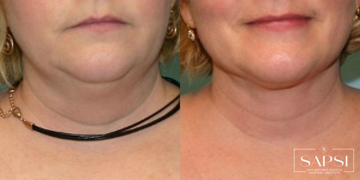 Liposuction: Patient 4 - Before