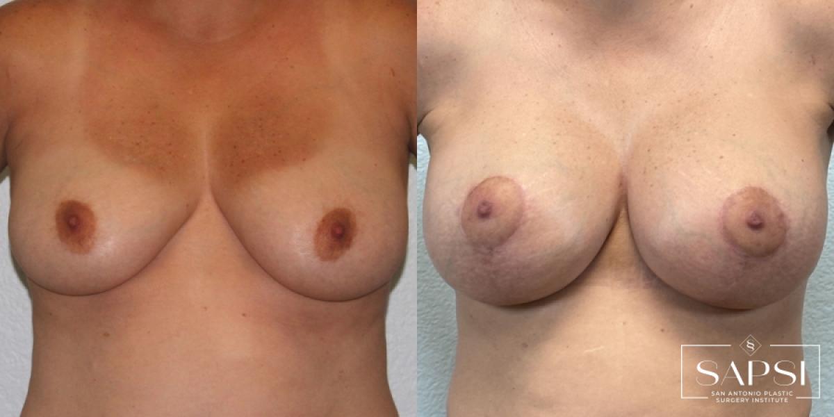 Breast Augmentation With Lift: Patient 20 - Before and After 