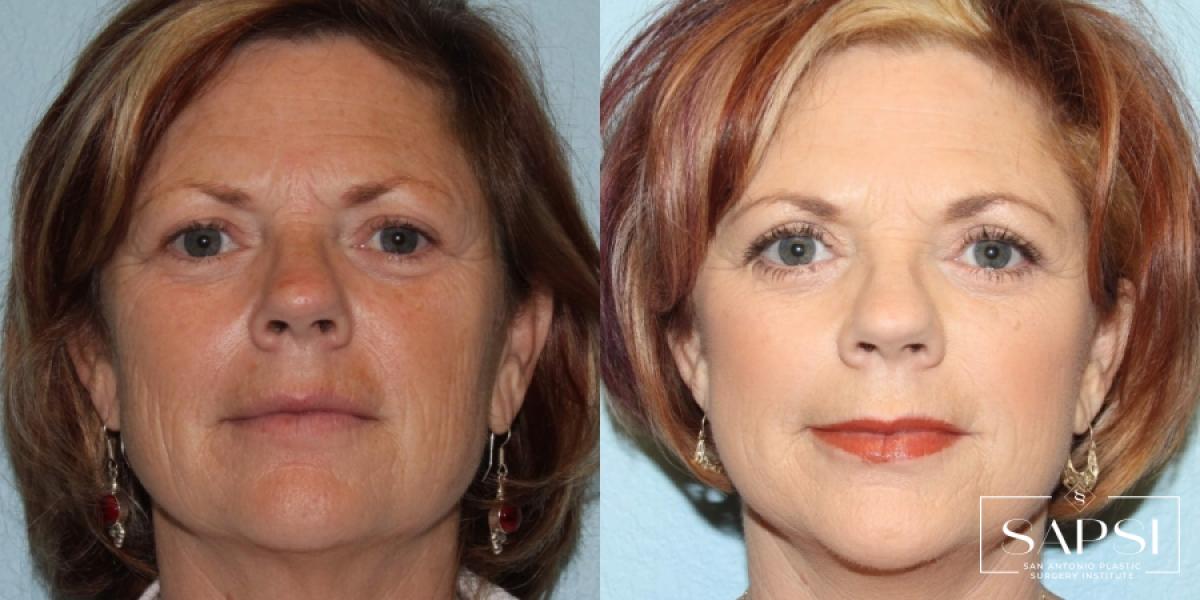Eyelid Surgery: Patient 1 - Before