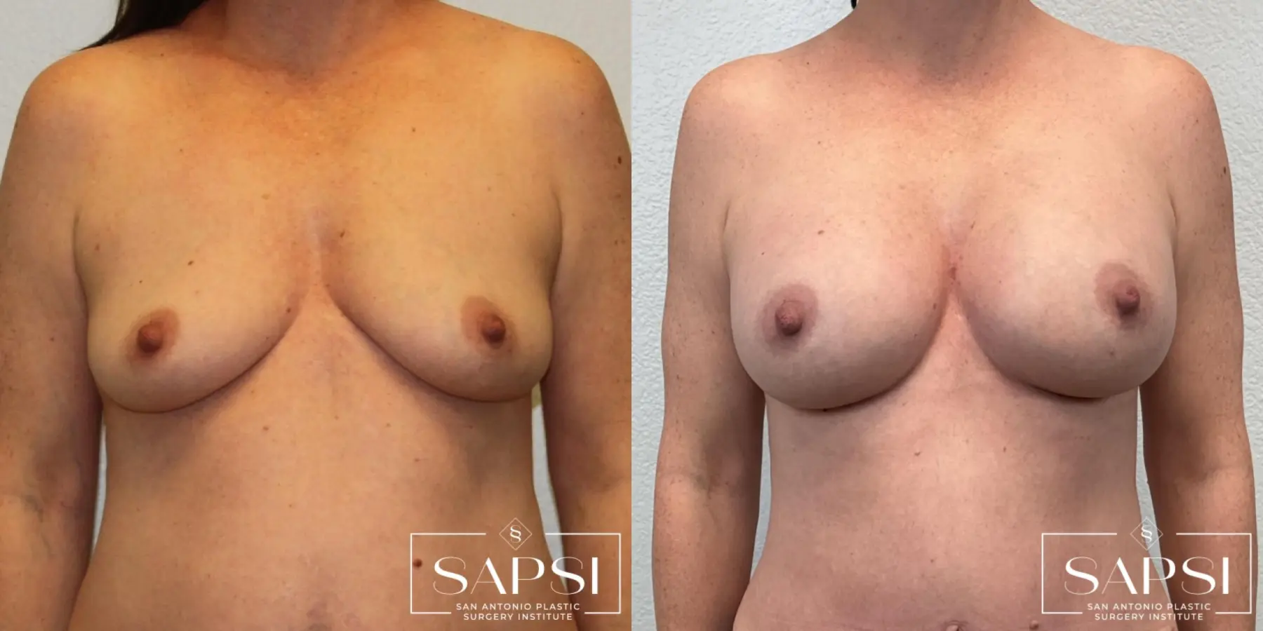 Breast Augmentation: Patient 4 - Before and After