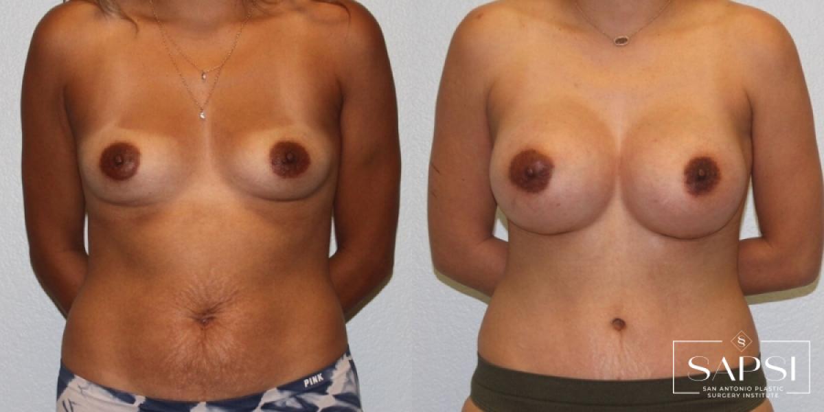 Mommy Makeover: Patient 33 - Before and After 