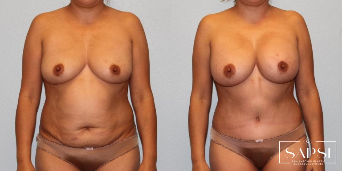 Mommy Makeover: Patient 12 - Before and After 