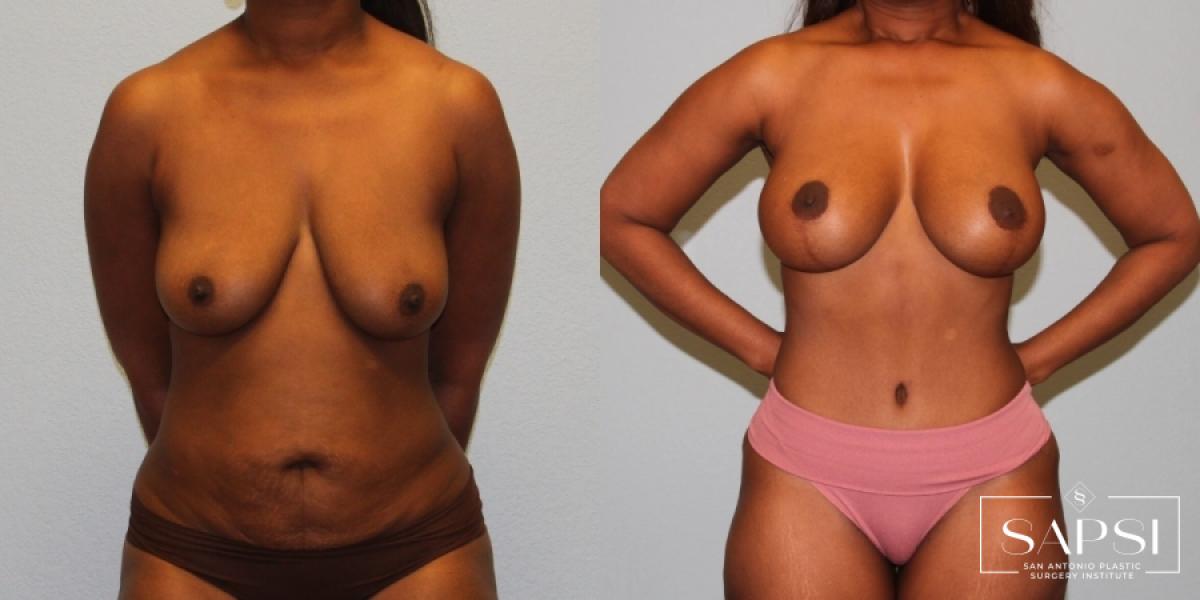 Mommy Makeover: Patient 10 - Before