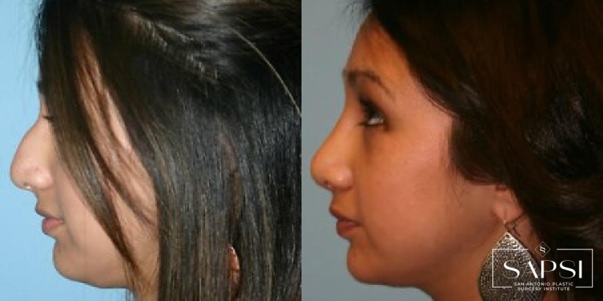 Facelift: Patient 3 - Before