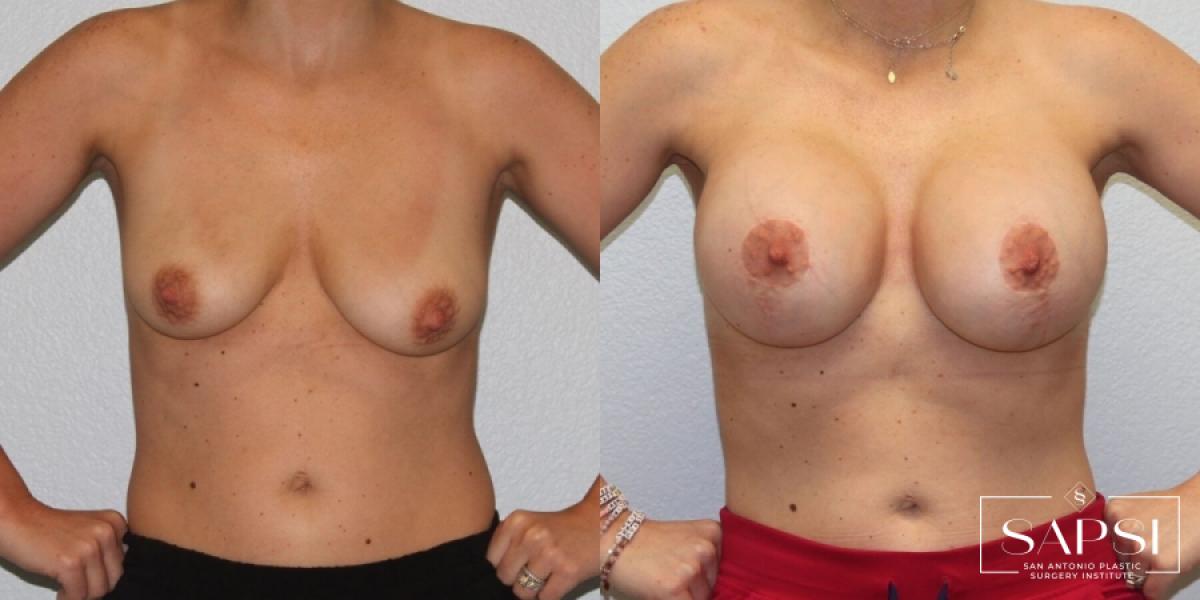 Breast Augmentation With Lift: Patient 9 - Before