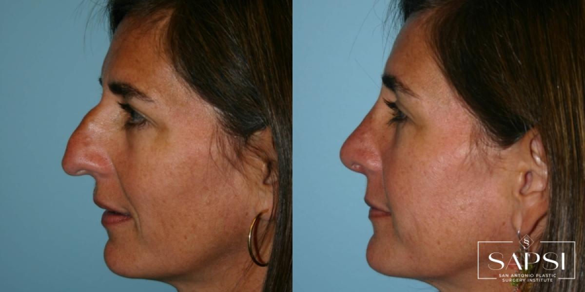 Rhinoplasty: Patient 1 - Before